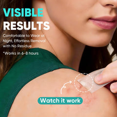 96-count pimple patches for facial back and body use