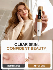 At home use device for removing skin tags and small moles