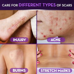 Surgical acne scar treatment Cicatricure gel text
