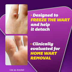 Cryotherapy wart remover applicator tip close up