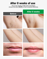 home-use full body ipl device