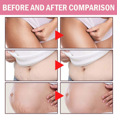 Stretch marks targeted by JINMAO Adeus Crema Brasileña cream