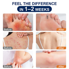 Kerova Antifungal Cream for jock itch relief