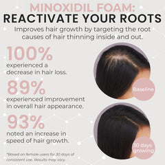 Minoxidil hair regrowth foam for women packaging