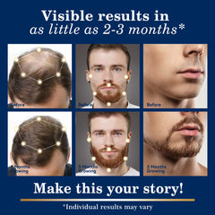 fragrance free minoxidil spray kit for sensitive scalp