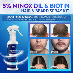 Minoxidil hair regrowth spray for women 60ml bottle
