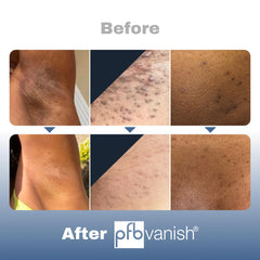 Ingrown hair treatment by PFB Vanish Chromabright easy application