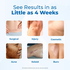 VitaMedica silicone scar gel for new and old scars