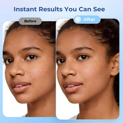 Daytime patches for ZITZIP face acne