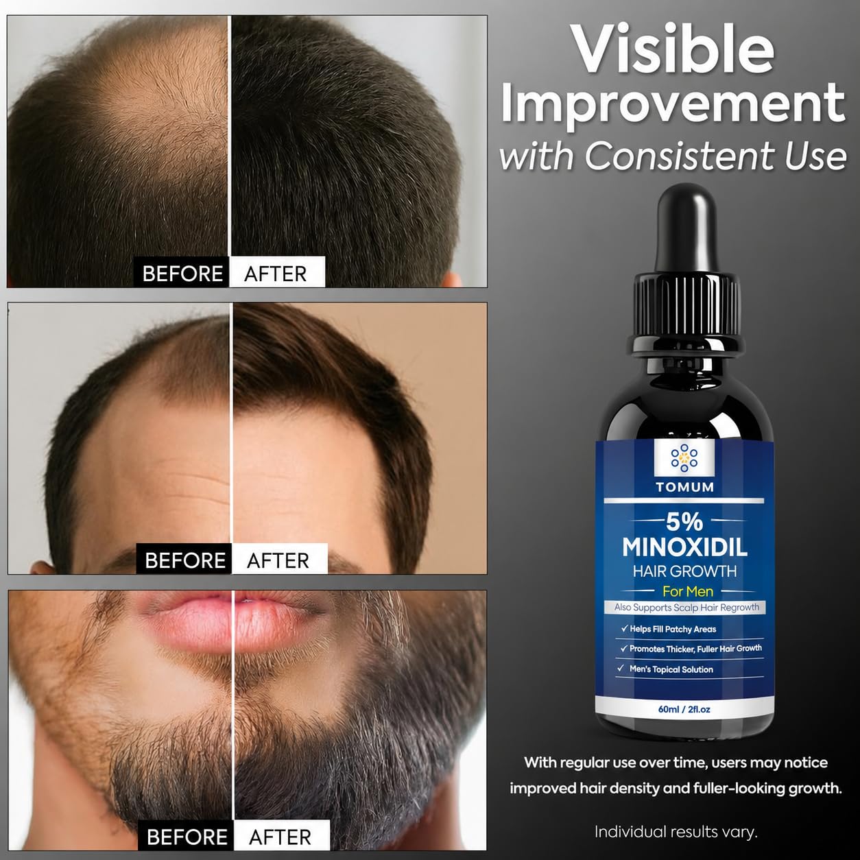 Minoxidil foam for thinning hair for men and women close up