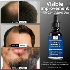 Minoxidil foam for thinning hair for men and women close up