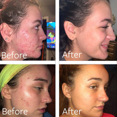 Acne Face Wash & Body Wash packaging with hyaluronic acid
