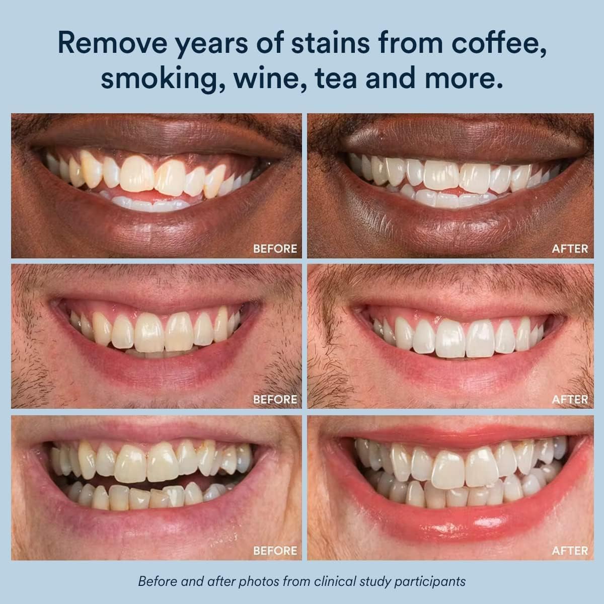 Works with Invisalign trays and custom dental trays