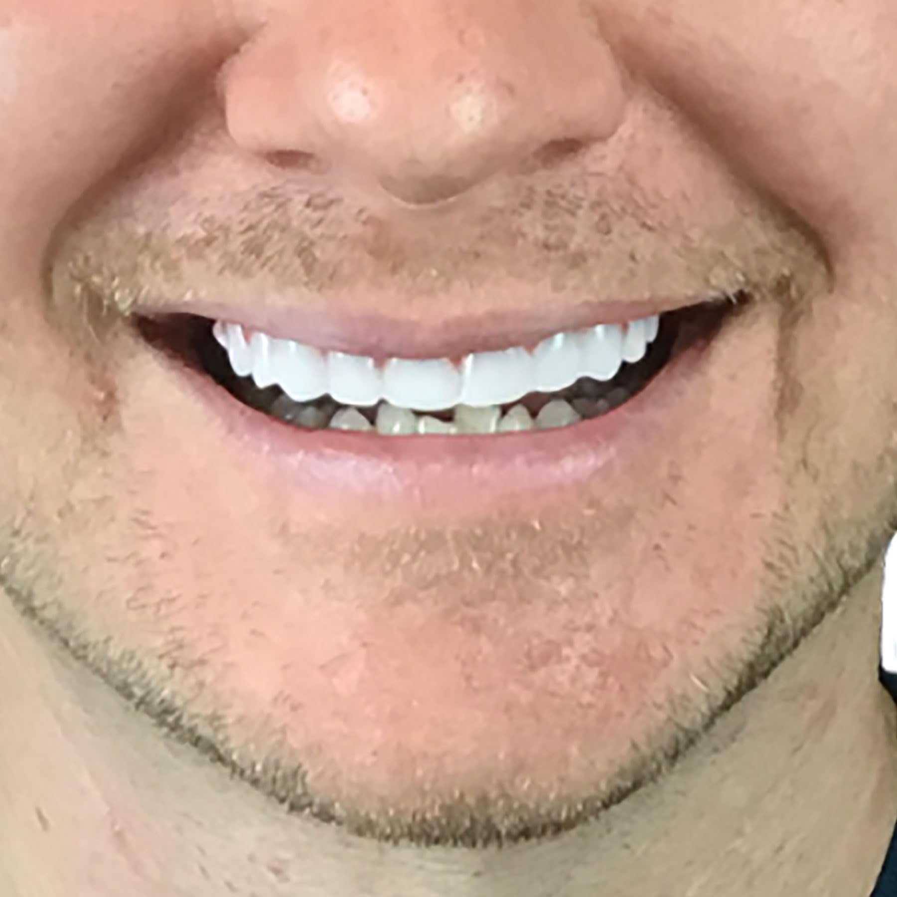 Sizing reference front four teeth approximately 1 1/8 inch across