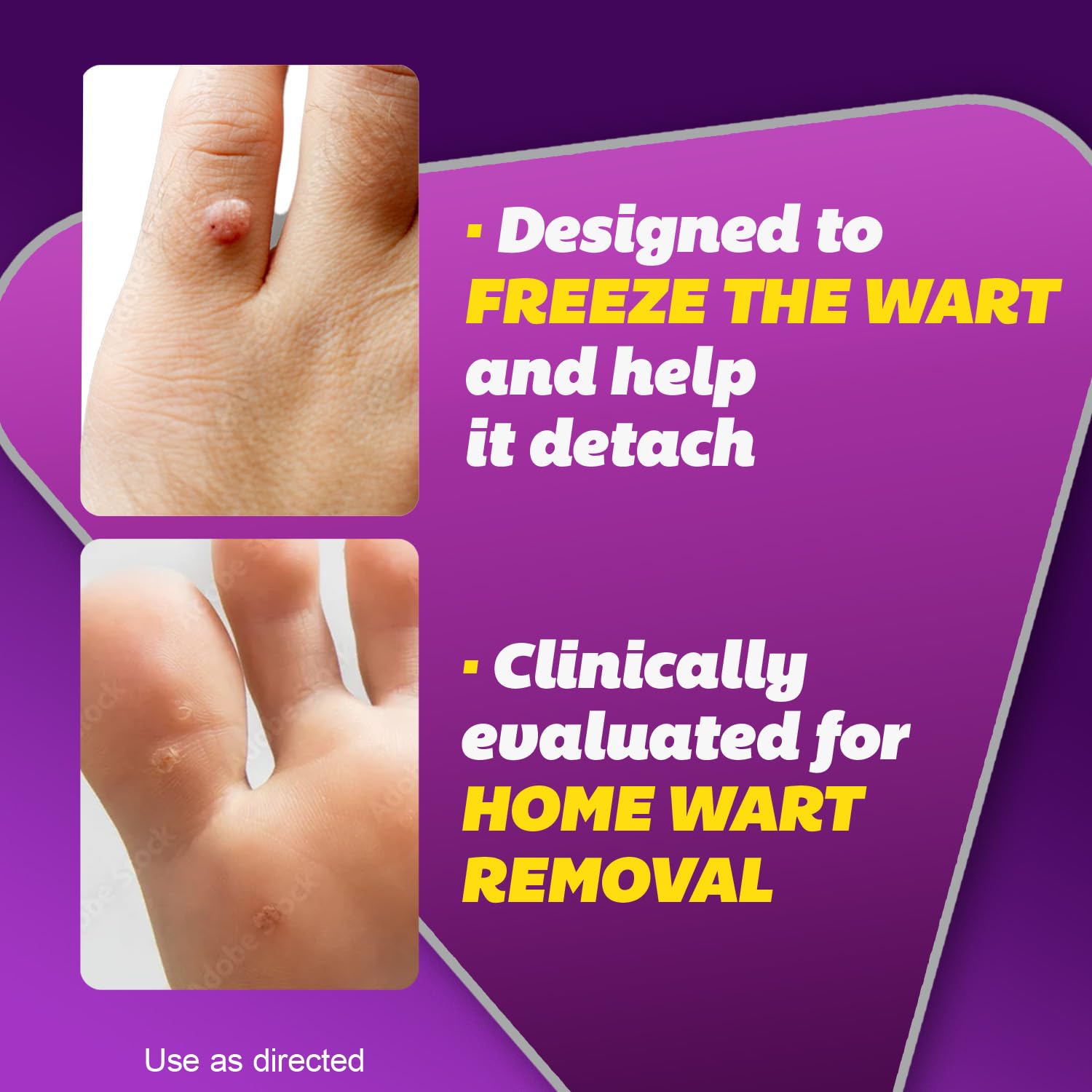 Cryotherapy wart remover applicator tip close up