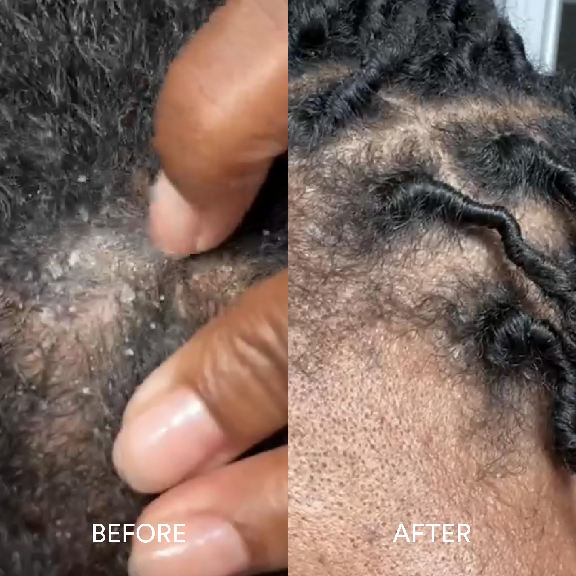 Dermazen anti-dandruff shampoo for daily use