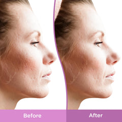Peptides including collagen in Differin Resurfacing Acne Scar Treatment Gel
