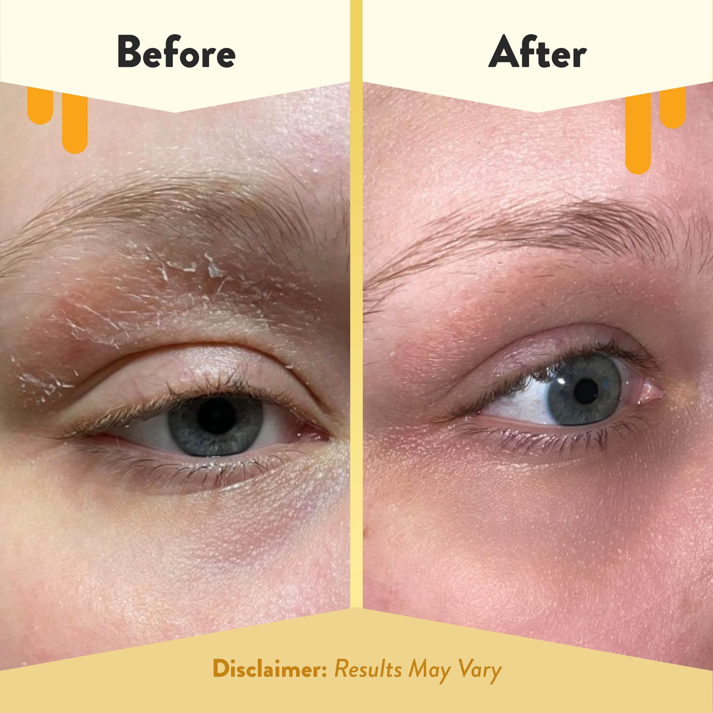 Eye Cream for eczema prone skin Eczema Honey 0.5 Oz