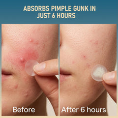 Hydrocolloid acne patches for face by TKGOU