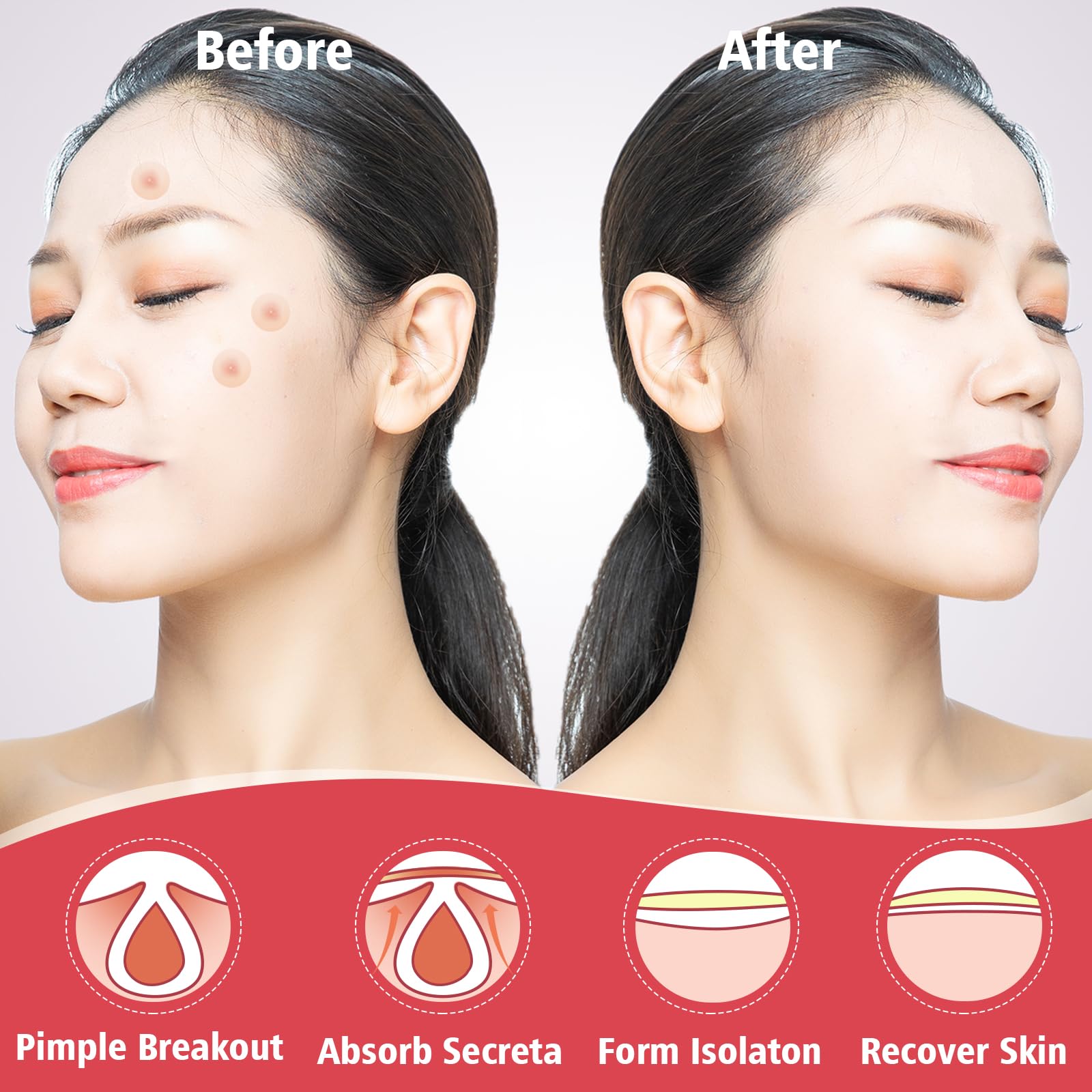 Hydrocolloid Acne Patches Zit Covers 10mm patches 120 counts
