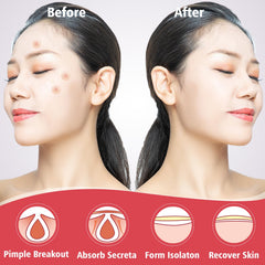 Hydrocolloid Acne Patches Zit Covers 10mm patches 120 counts