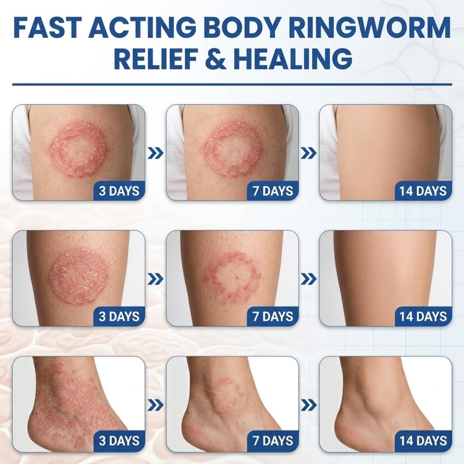 Jock itch and athletes foot treatment in tube