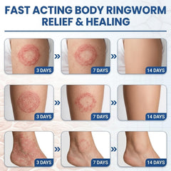 Jock itch and athletes foot treatment in tube