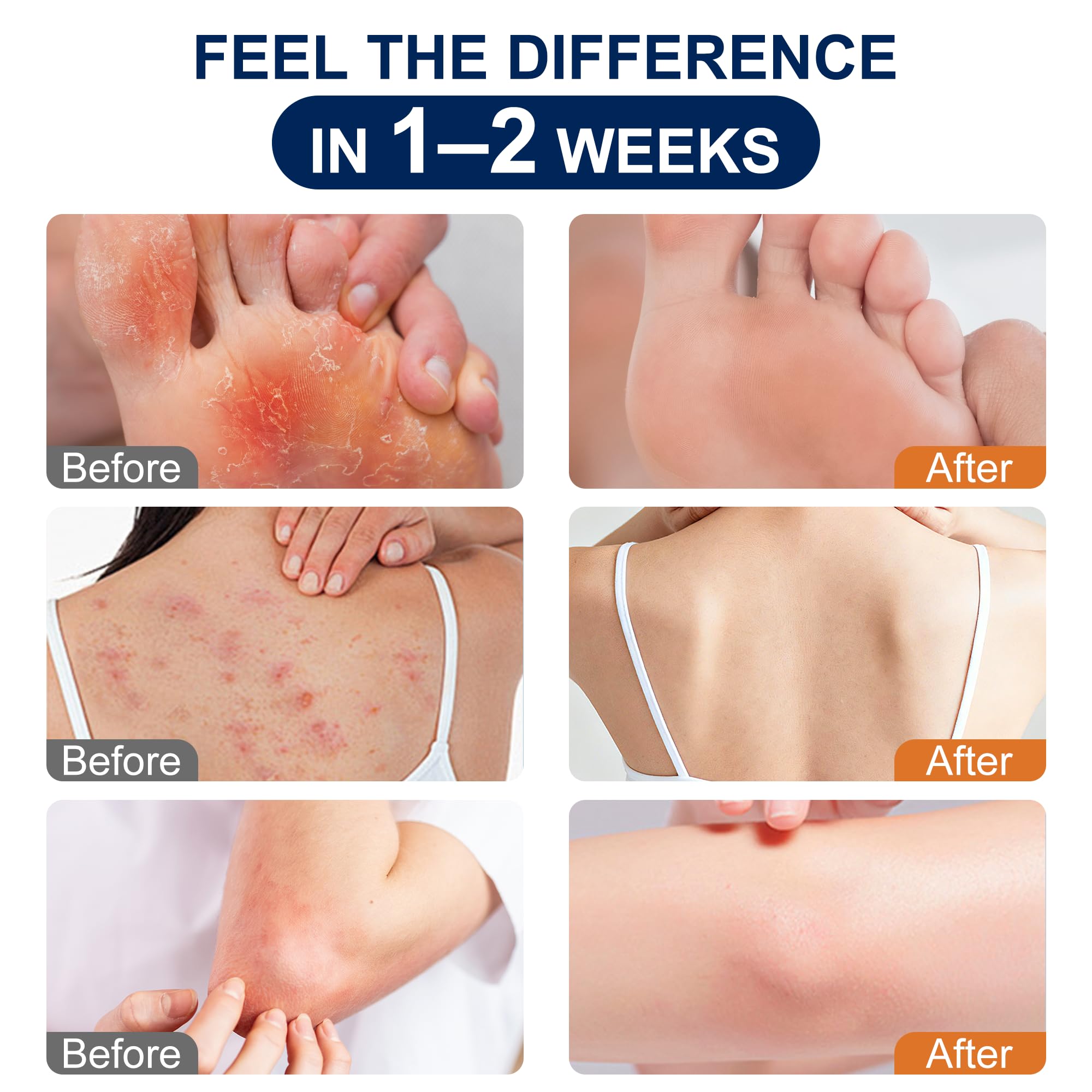 Kerova Antifungal Cream for jock itch relief