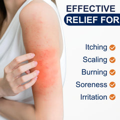 Kerova Antifungal Cream for ringworm relief