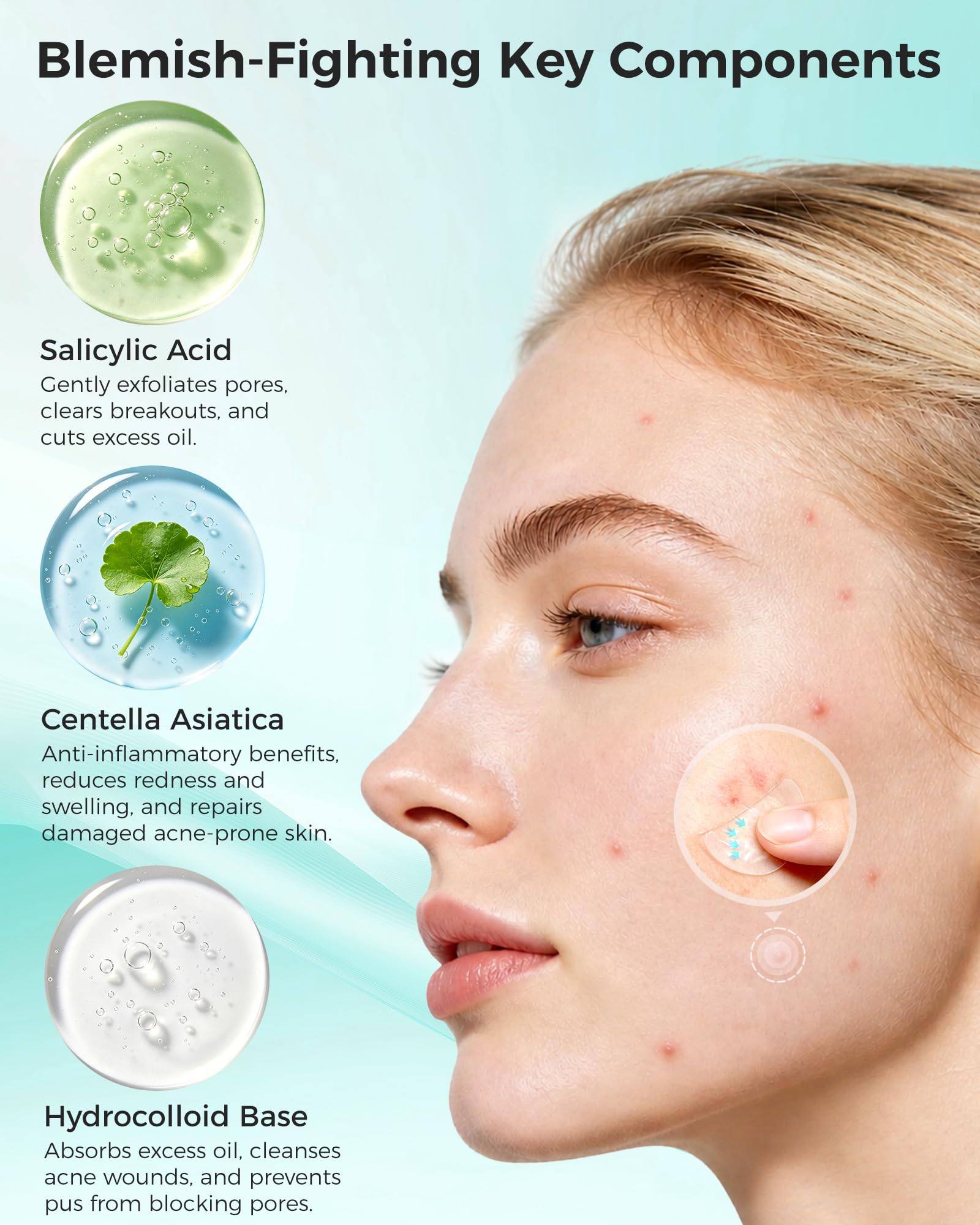 Hydrocolloid acne patch absorbing exudate