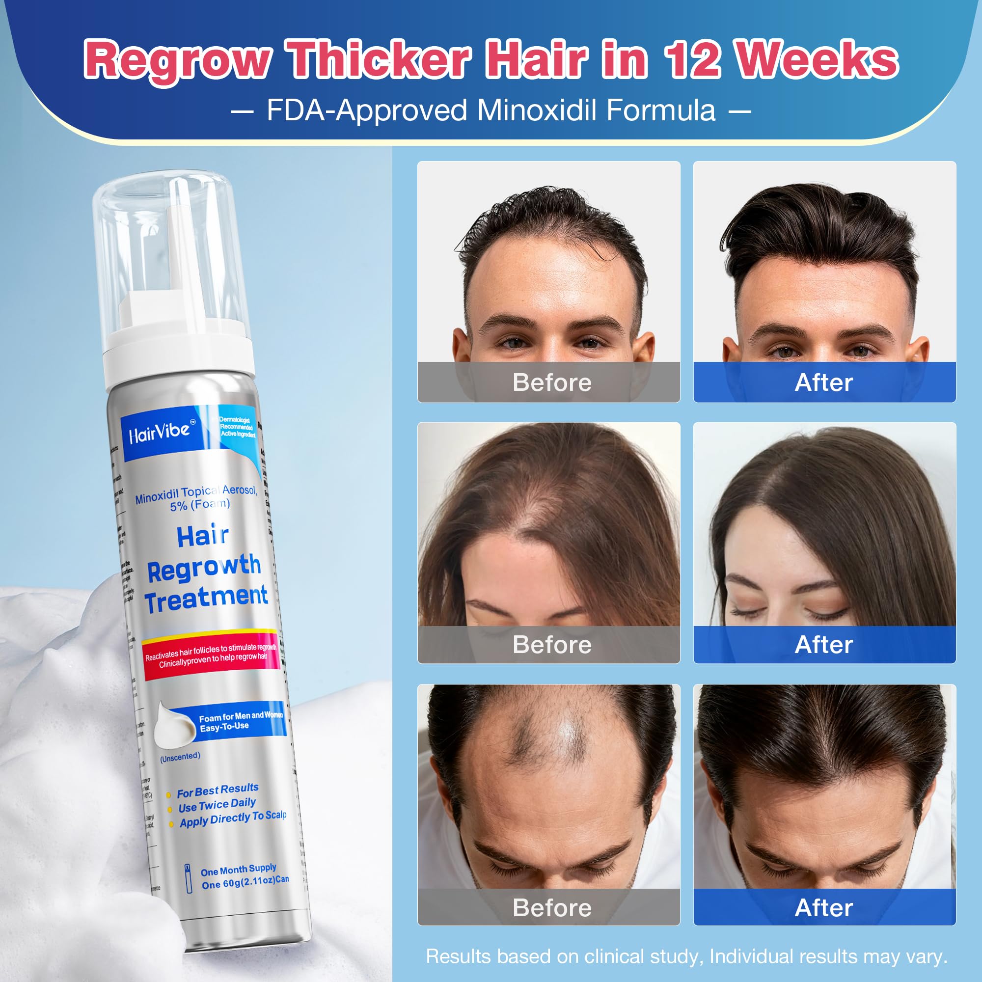 Minoxidil foam for part lines and diffuse thinning areas