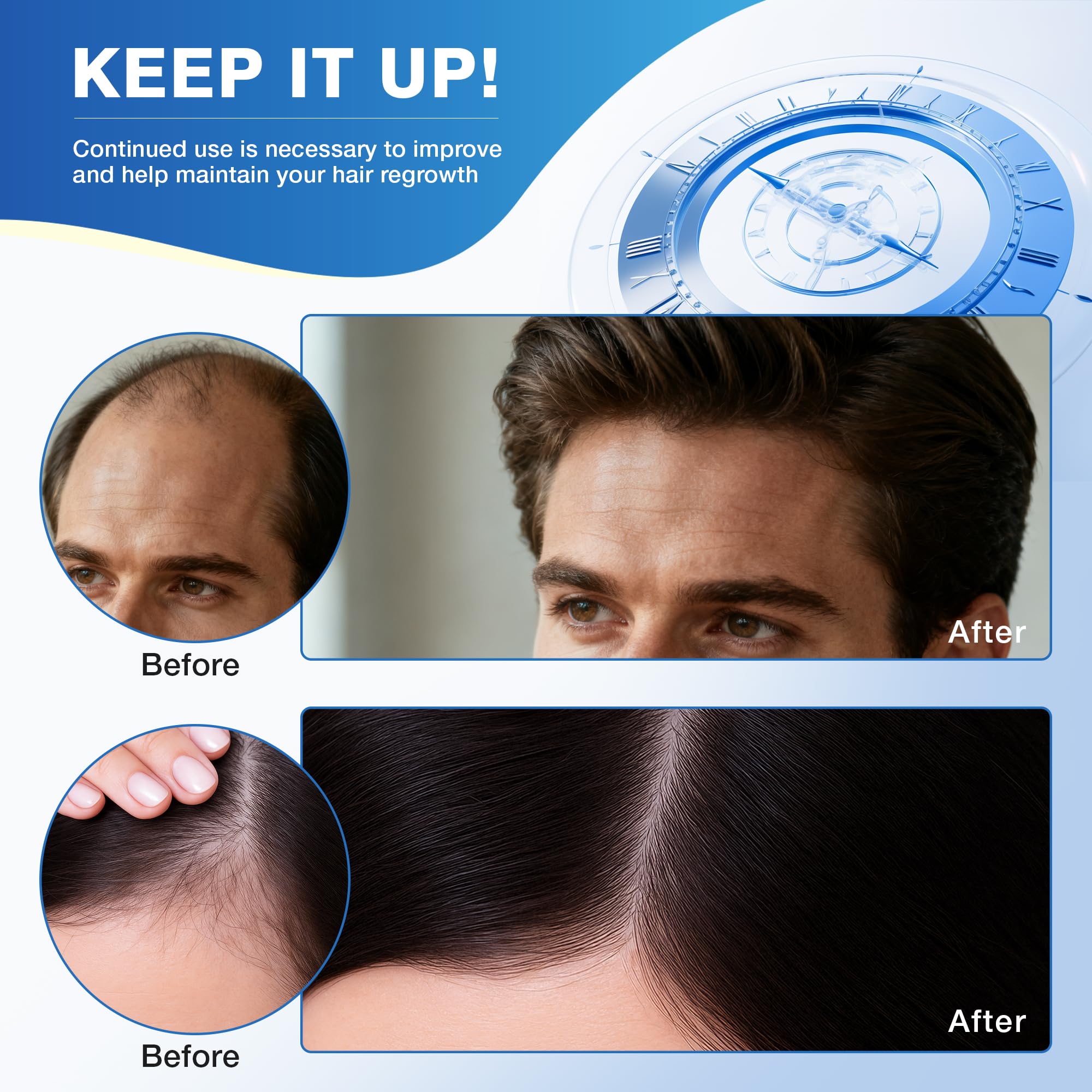 Minoxidil foam for scalp and beard in compact packaging