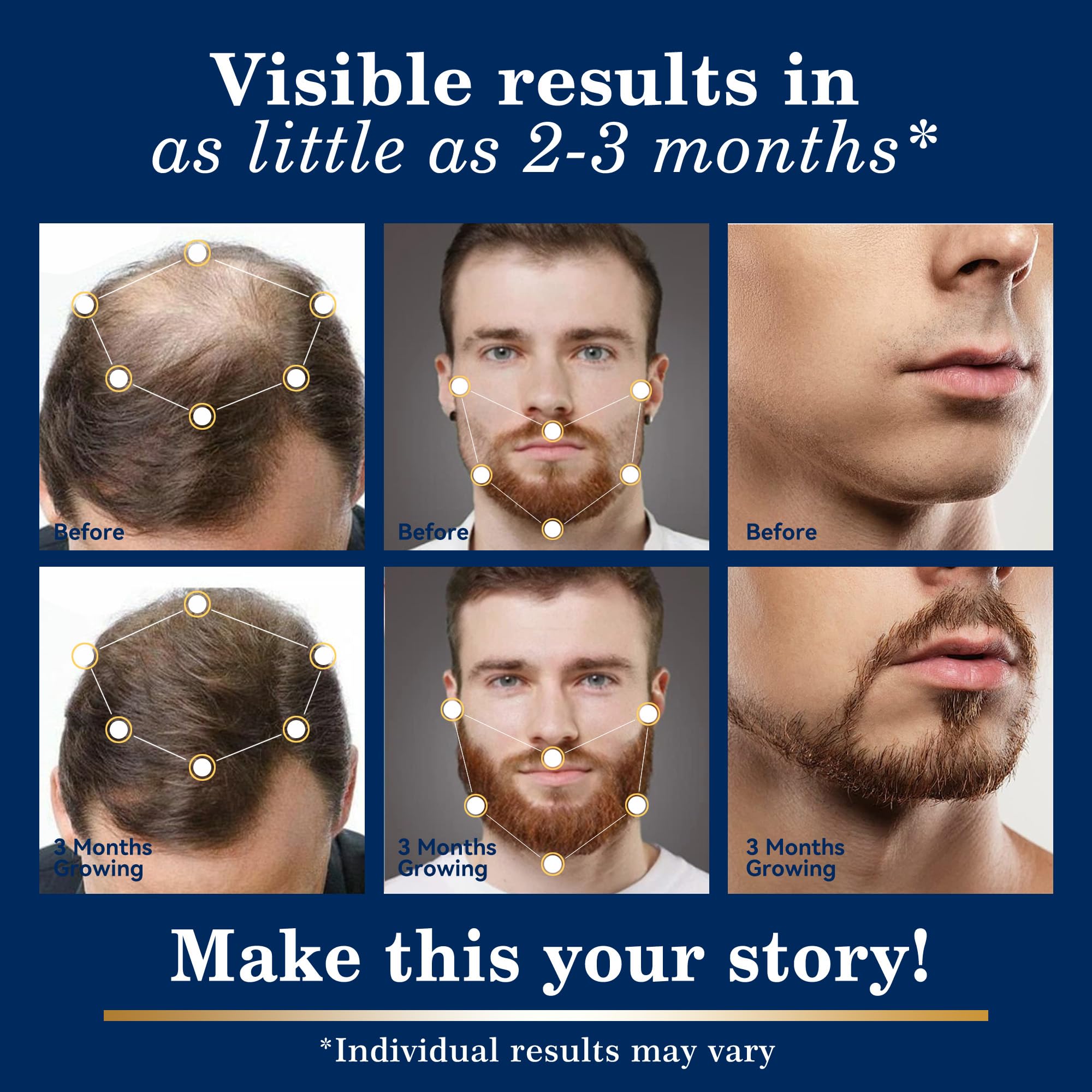 fragrance free minoxidil spray kit for sensitive scalp