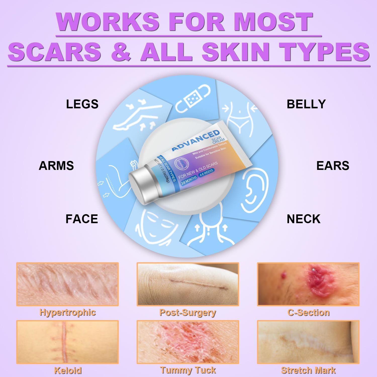 Scar treatment for stretch marks acne and injuries