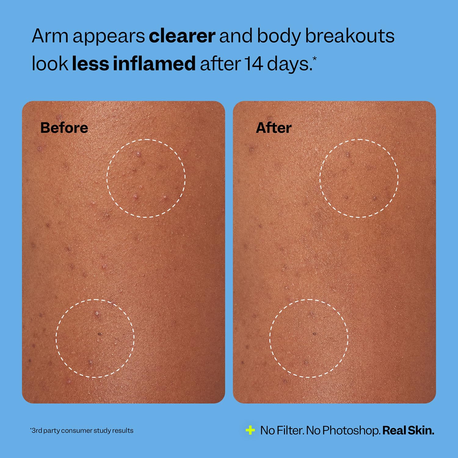 K-beauty inspired patch for body acne