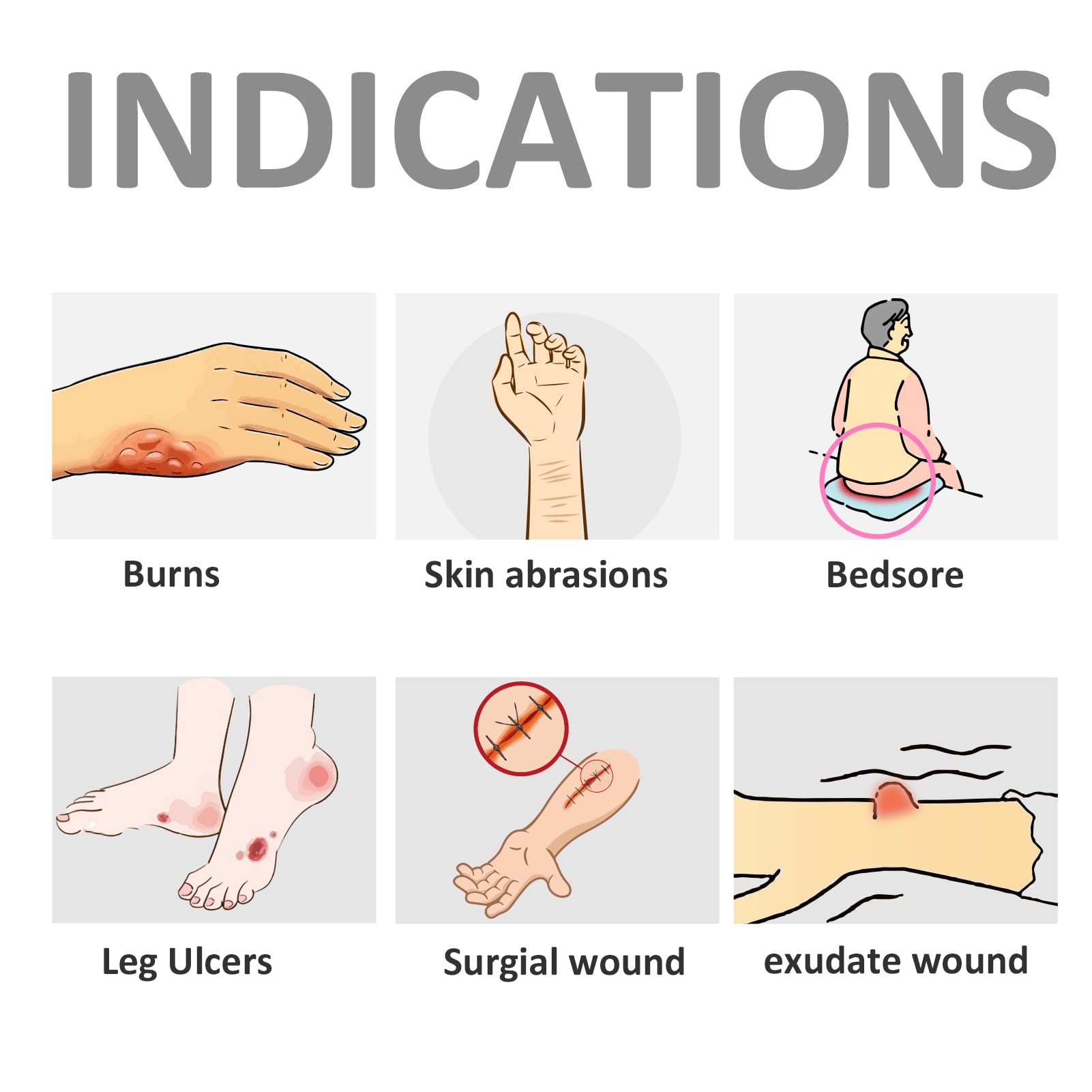 Seaweed-derived highly absorbent wound dressing