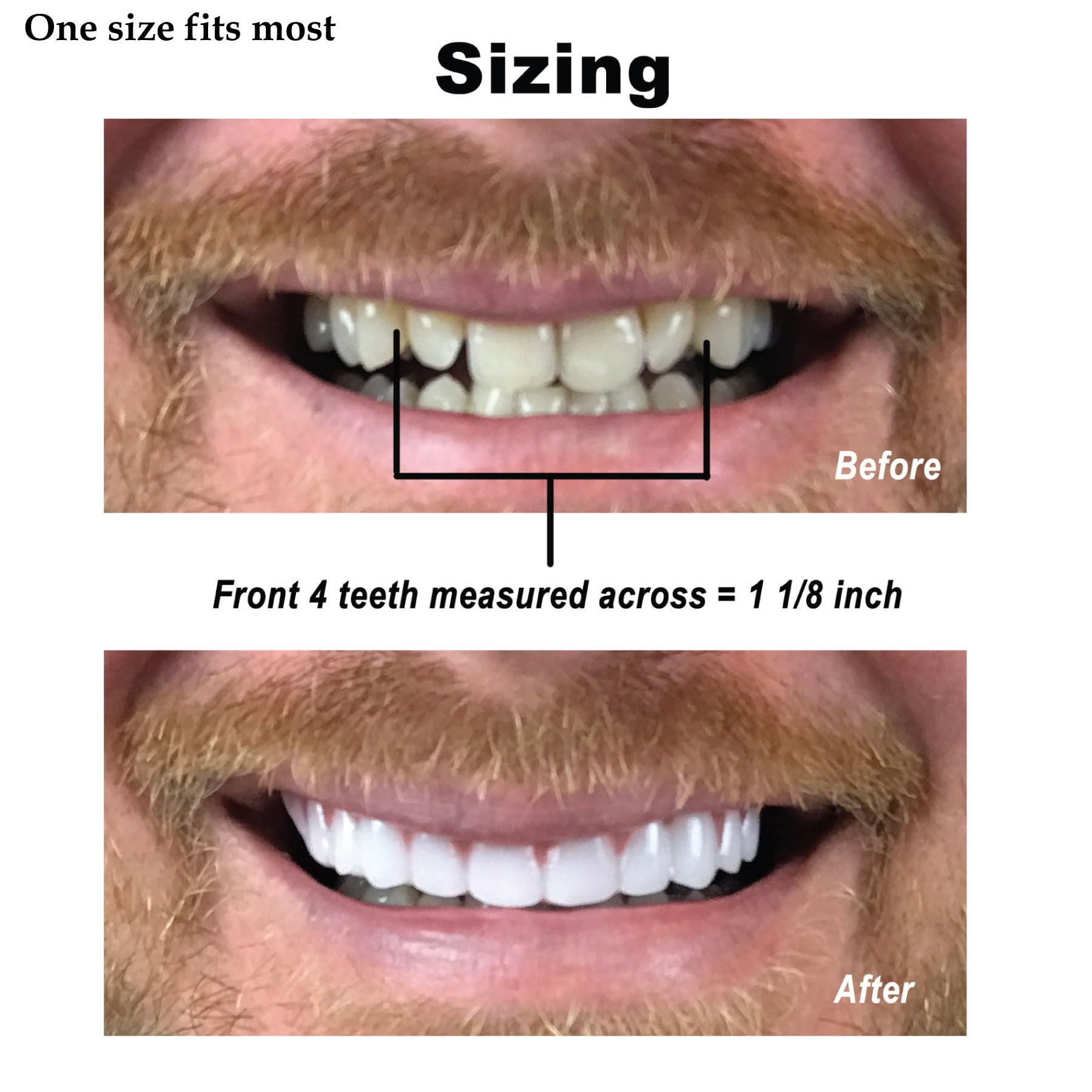 Cosmetic teeth designed for quick at home smile update