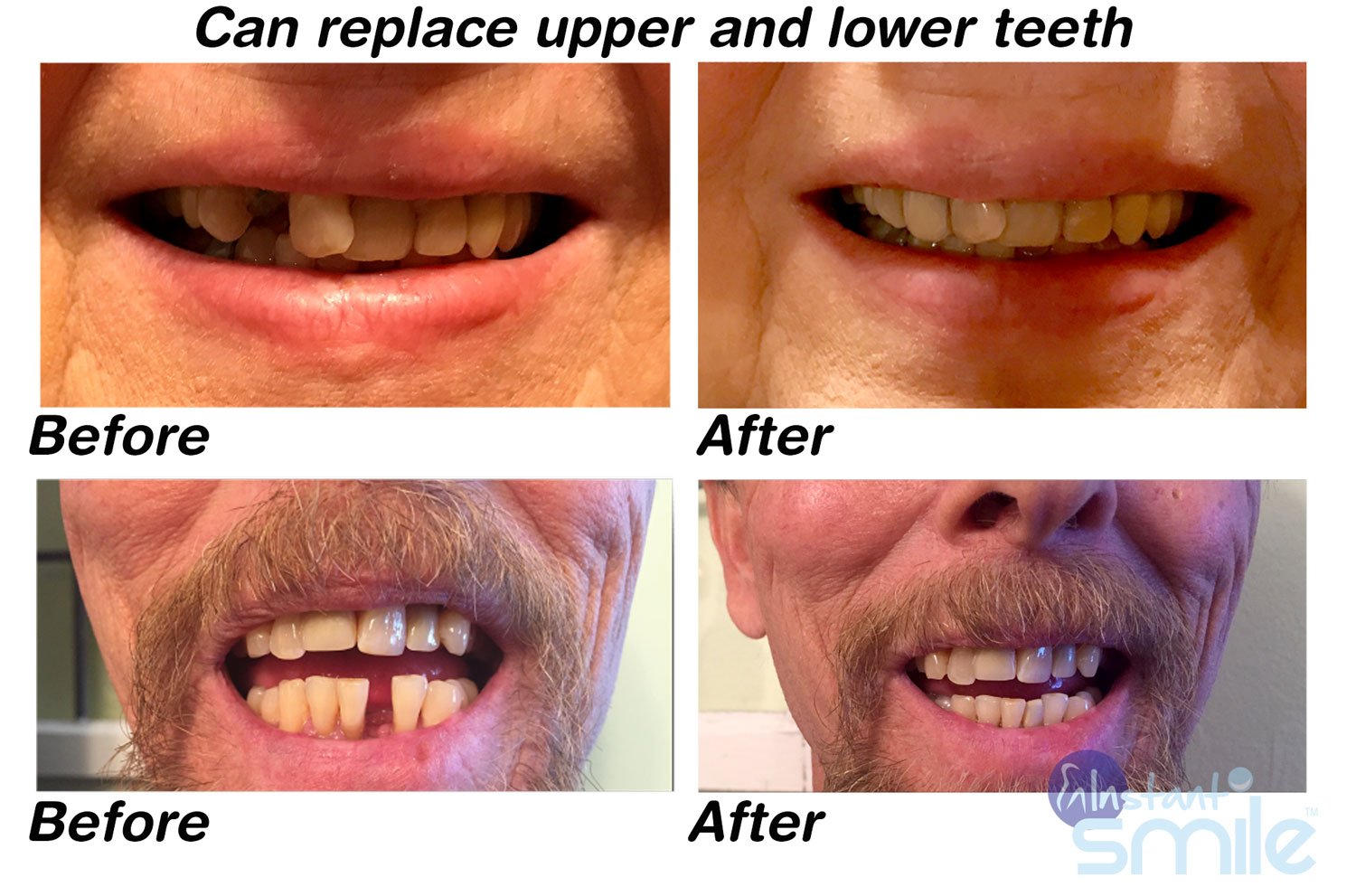 Customizable teeth set for natural appearance