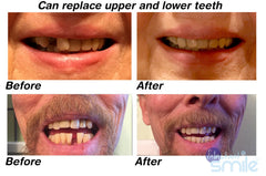 Customizable teeth set for natural appearance