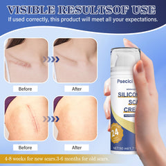 Scar removal cream Psecici for burns acne scars 1.7 oz