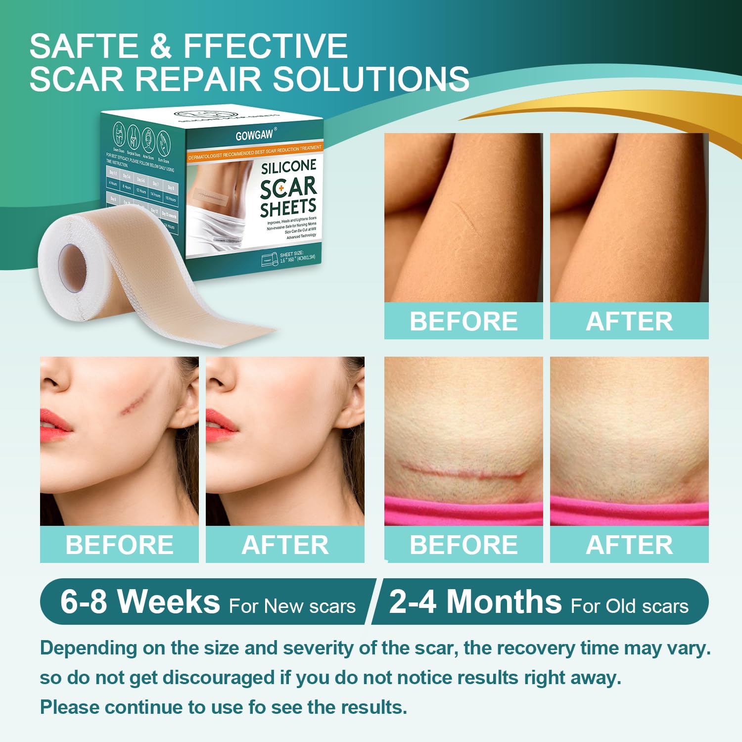 C-section scar silicone sheets image