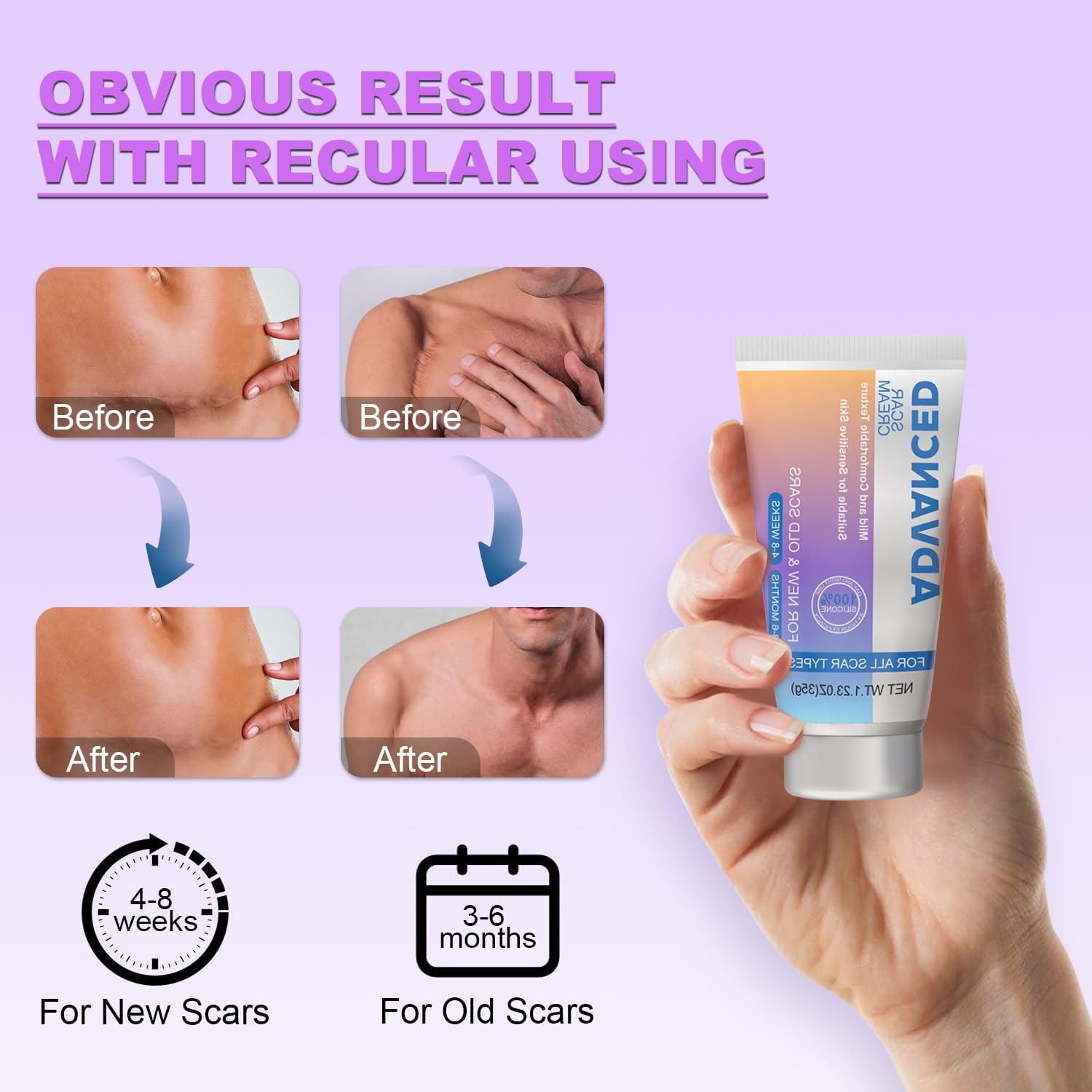 Old and new scars treated with silicone scar gel 35g
