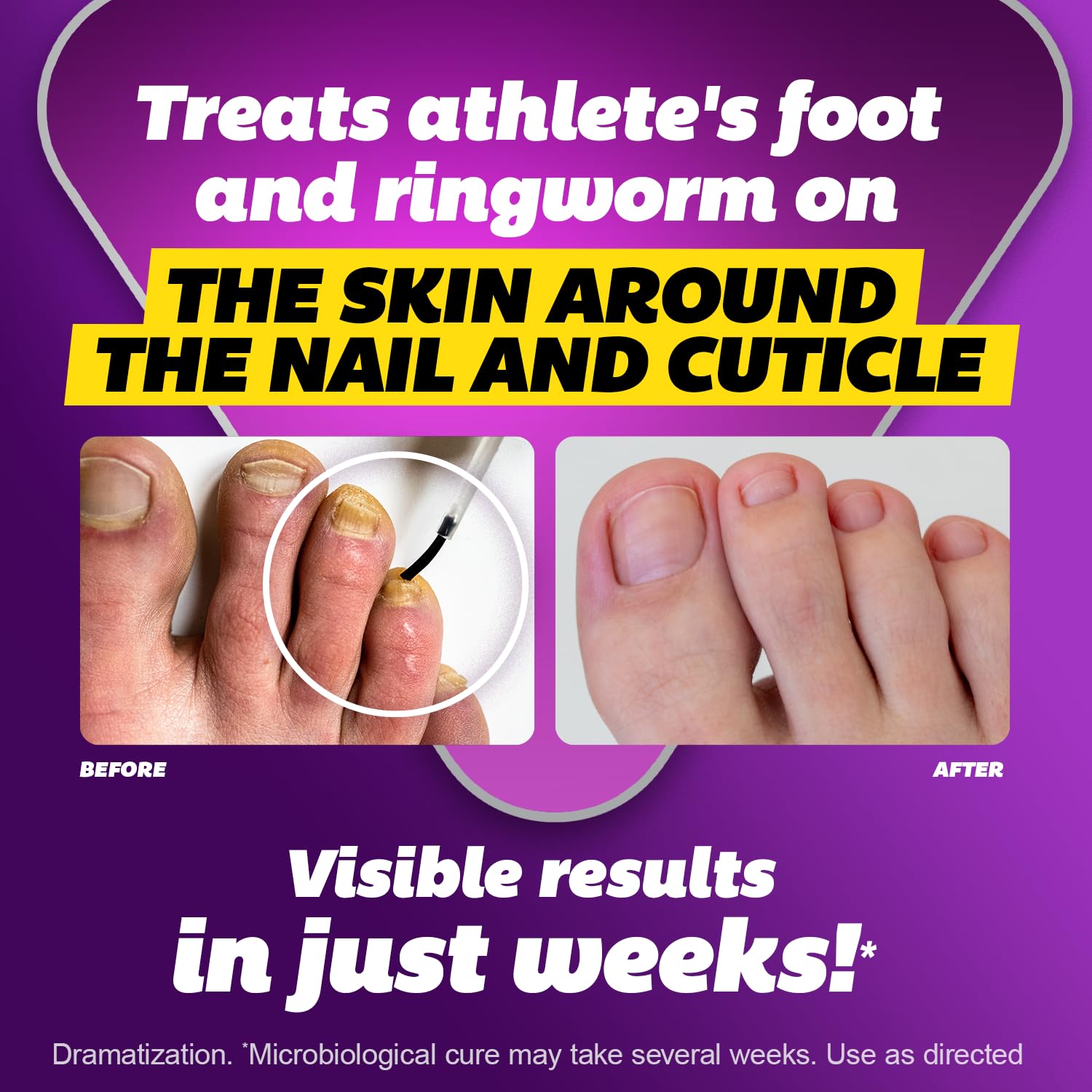 0.45 oz bottle size for toenail treatment