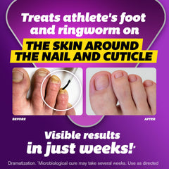 0.45 oz bottle size for toenail treatment