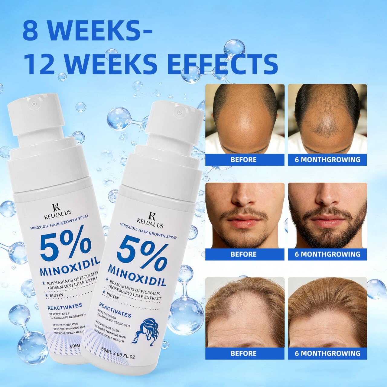 Upgraded formula KELUAL DS minoxidil with aloe vera
