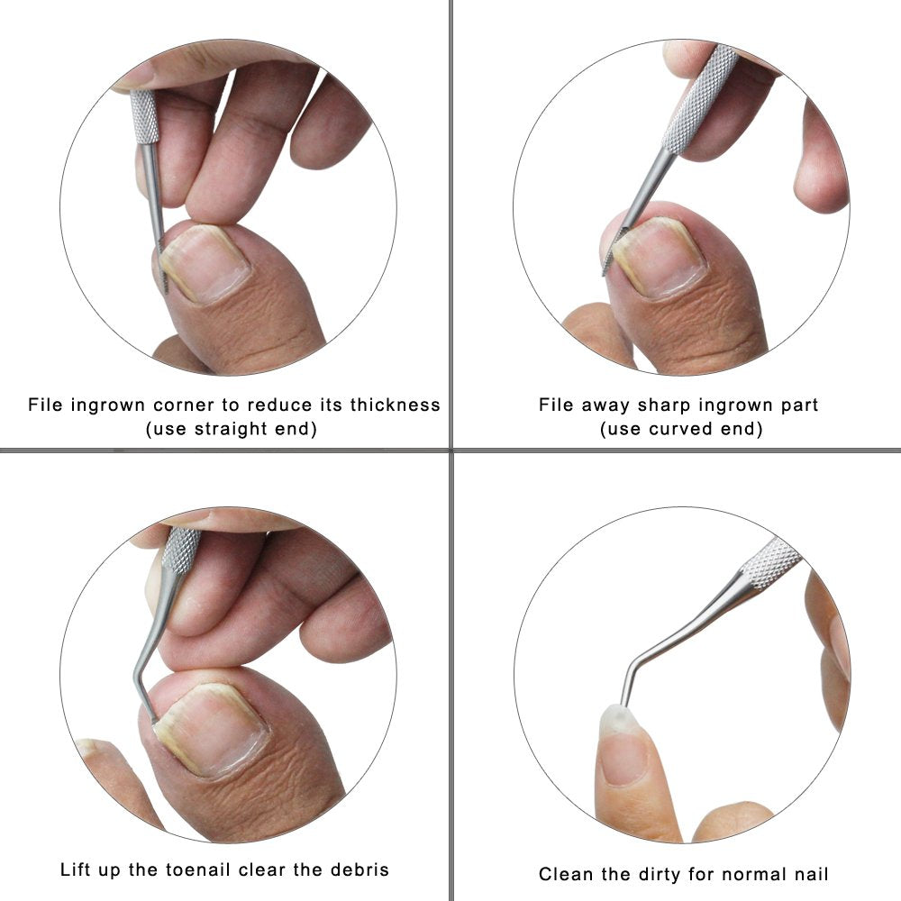 Storage case compatible ZIZZON ingrown toenail care tools